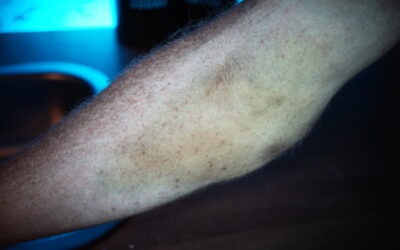 University of Copenhagen Study Examines Bruise Documentation with Crime-lite® AUTO